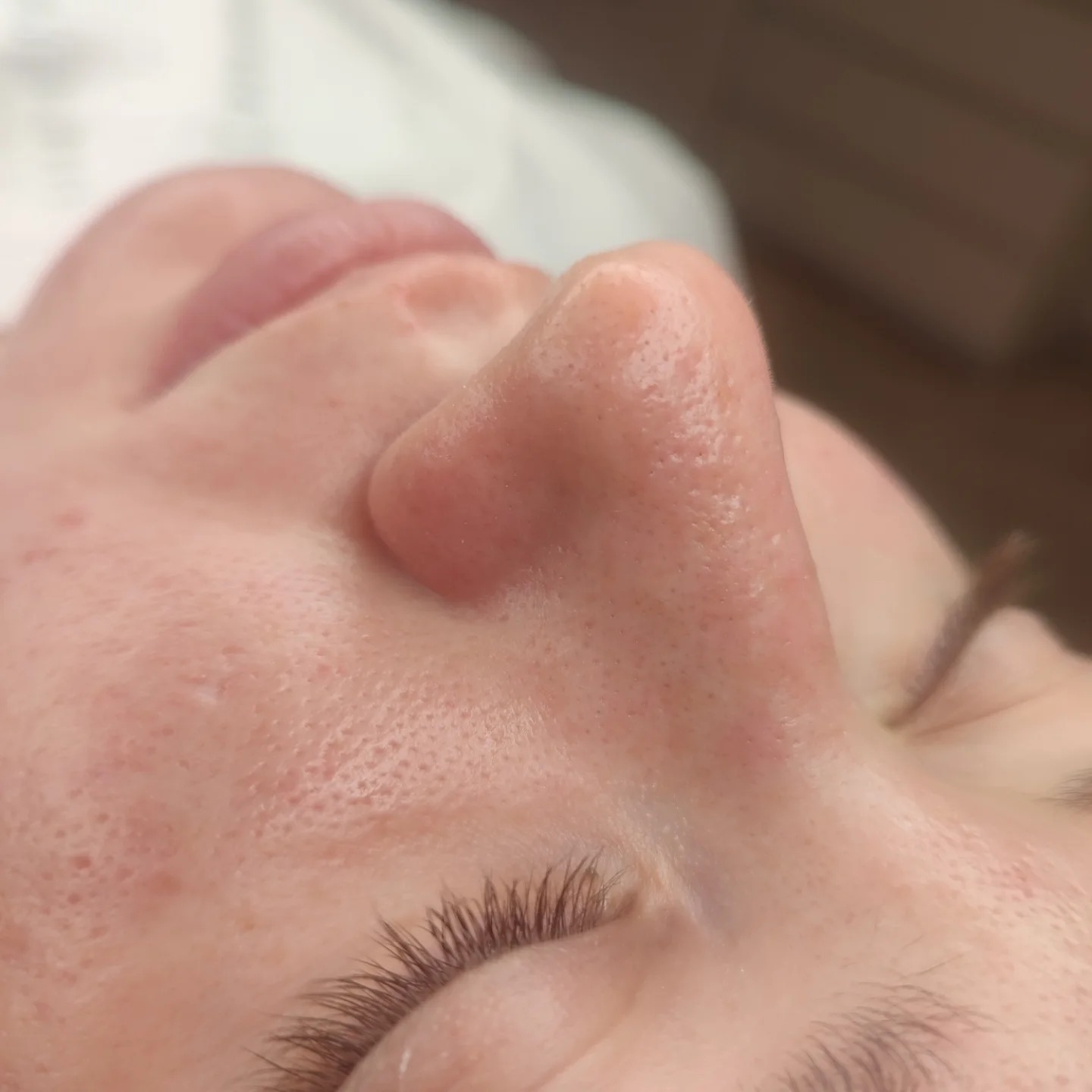 Обличчя після механічної чистки — косметолог Ангеліна Дарієнко Миколаїв